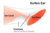 Surfer's Ear